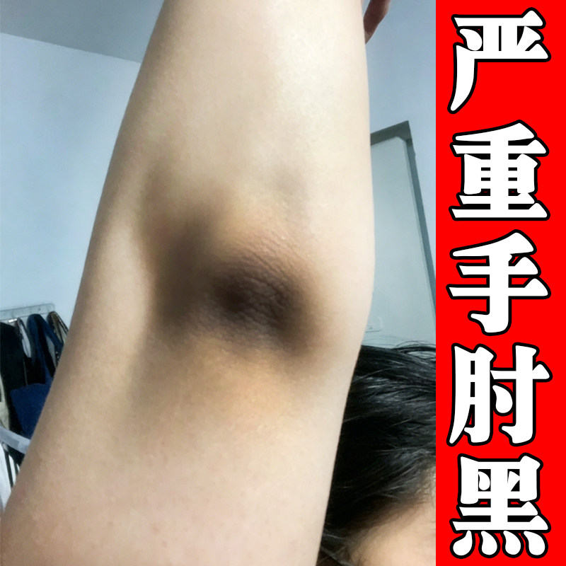 严重手肘黑外用修复去胳膊肘黑皮肤黑色素沉淀除膝盖腋下脖子黑