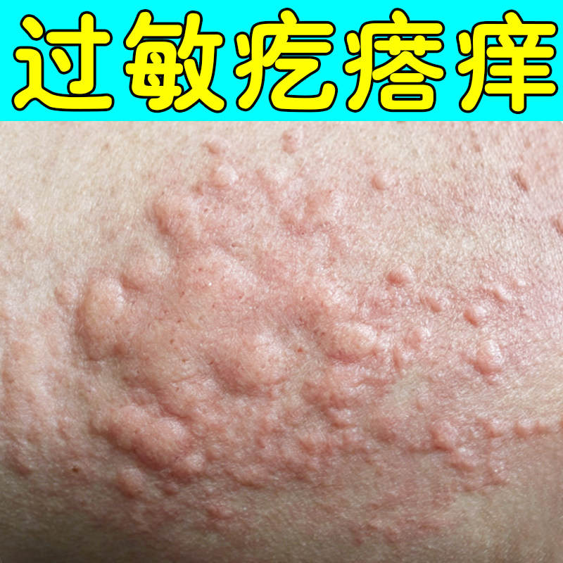 过敏疙瘩痒身上痒起红肿疙瘩痘痘皮肤干燥粗糙痒长红斑痒外用药