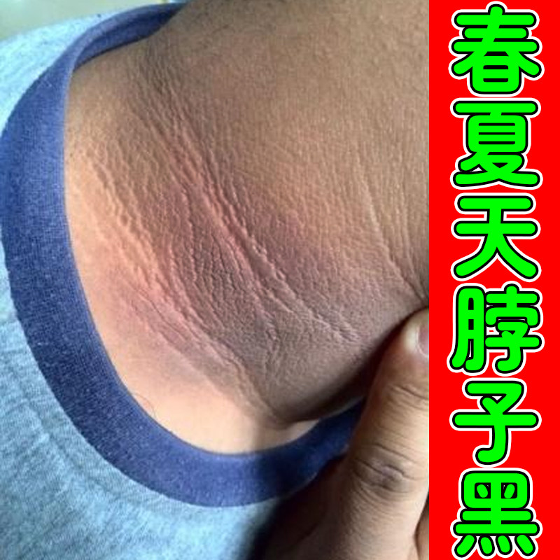 脖子黑春夏天气热身上皮肤晒黑儿童膝盖关节手肘黑色素沉淀