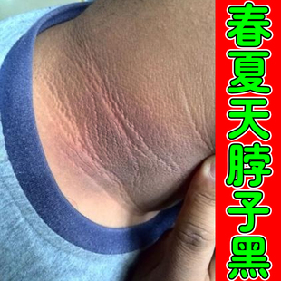 脖子黑春夏天气热身上皮肤晒黑儿童黑棘皮膝盖关节手肘黑色素沉淀