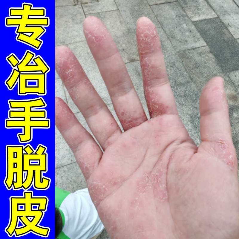 专冶手脱皮的药手掌掉皮起皮手部粗糙干燥换季脱屑手指起干皮软膏