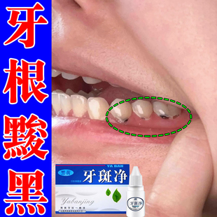 牙斑净牙缝发黑清理神器牙菌斑牙根黢黑黄牙齿烟渍茶渍黑渍