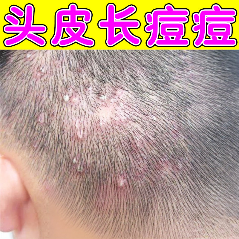 头皮长痘痘头痒刺痛头皮出油快头屑反复头皮红点小疙瘩头皮闷包痒