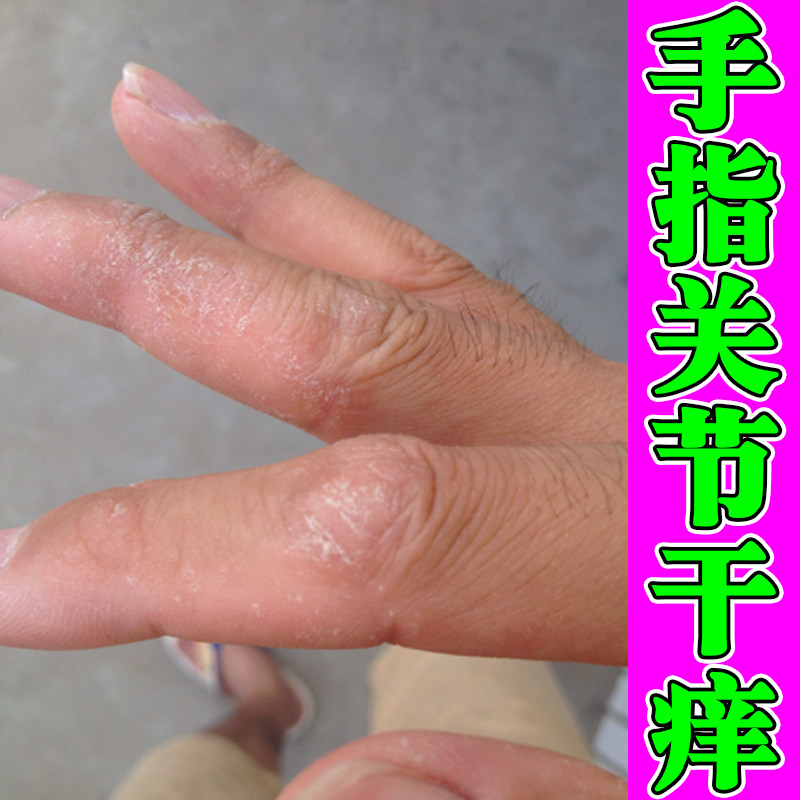 手指关节干痒粗糙起皮脱皮专用成人儿童神经性皮肤痒过敏掉屑痒