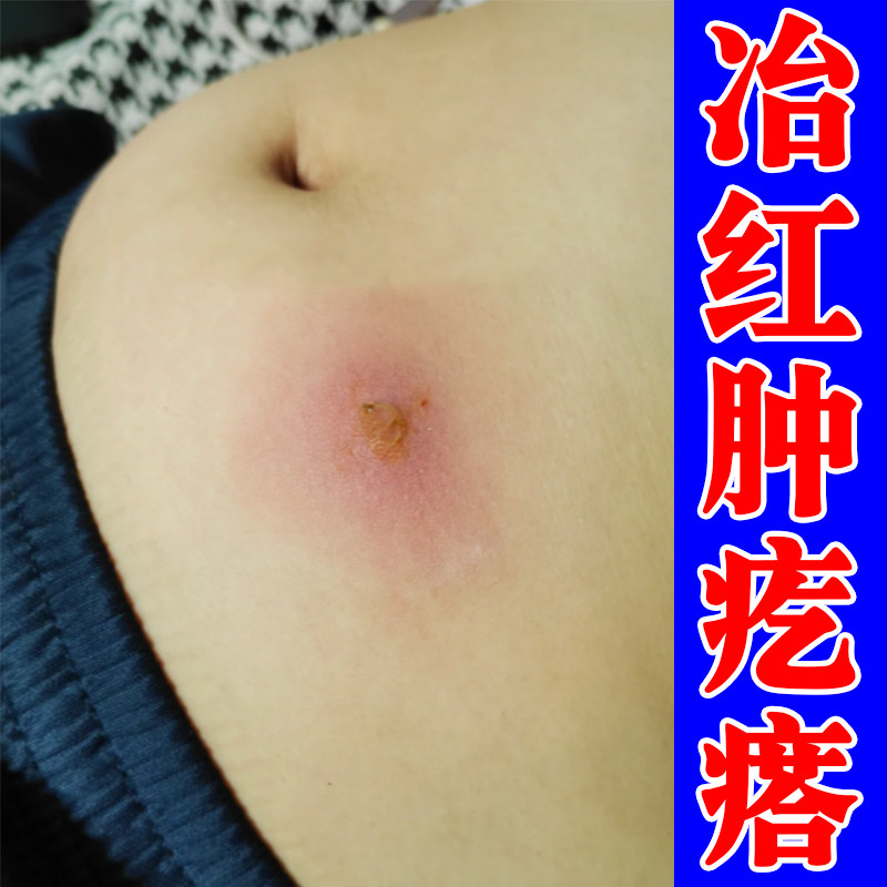 火疖子药软膏肚子身上脸上起红斑硬块疙瘩红肿疼痛拔毒脓包的神器