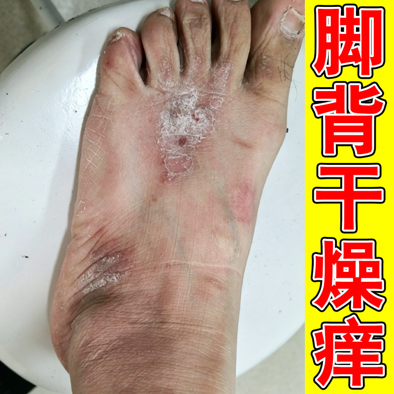 脚背干燥痒脚面皮肤过敏起皮脱屑真菌脚痒粗糙掉皮长小水泡痒修复