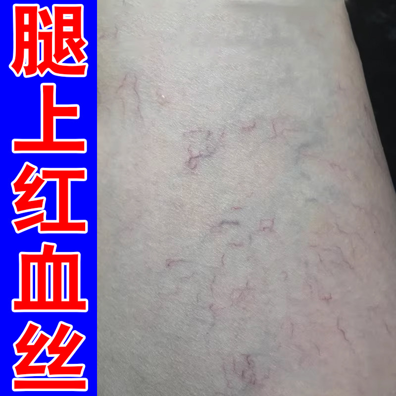 腿上有红血丝去男女下肢毛细血管扩张青筋凸起外用冷敷凝胶药