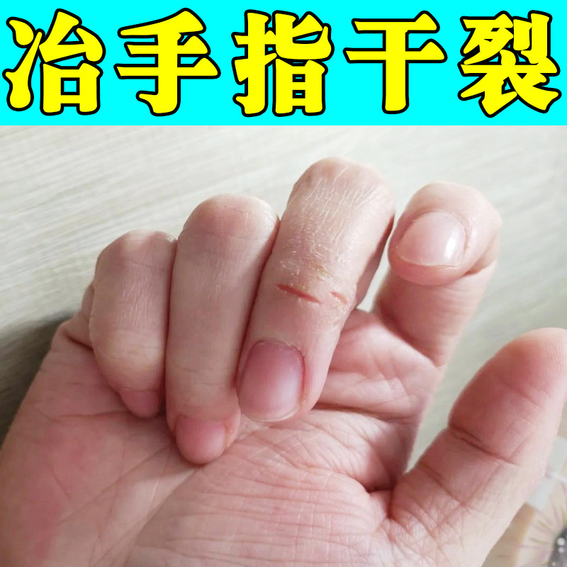 冶手指干裂粗糙起皮裂口子手指关节痒季节性手脱皮起皮干燥外用膏
