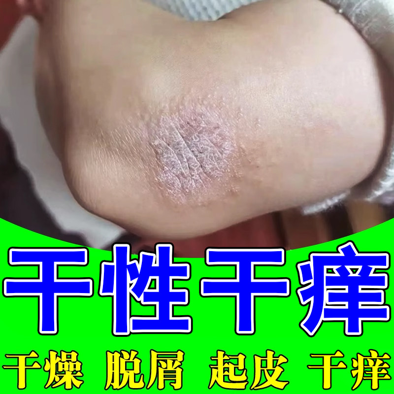 胳膊关节痒手肘燥粗糙起皮屑掉皮痒婴儿成人专用无激素软膏