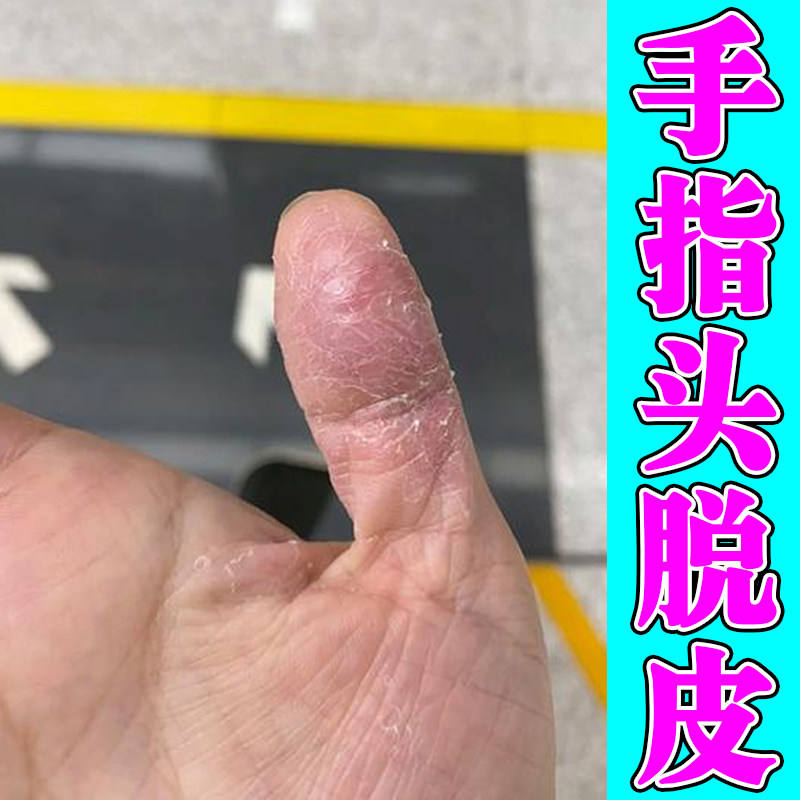 手指头脱皮专用干燥粗糙换季手严重蜕皮药季节性真菌手脚干裂软膏