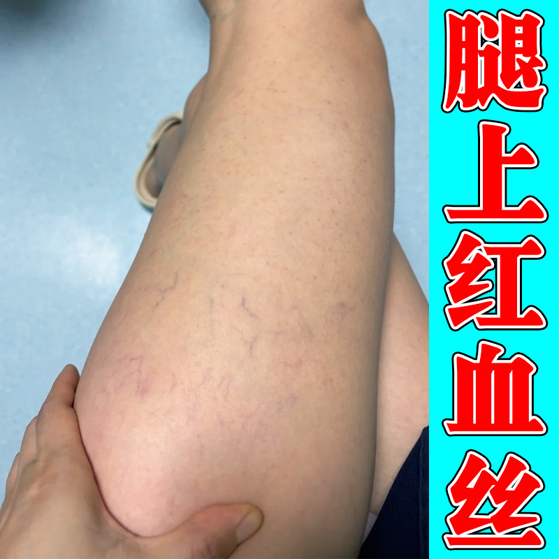腿上红血丝男女下肢毛细血管扩张小腿手背胳膊青筋凸起血丝腿专用