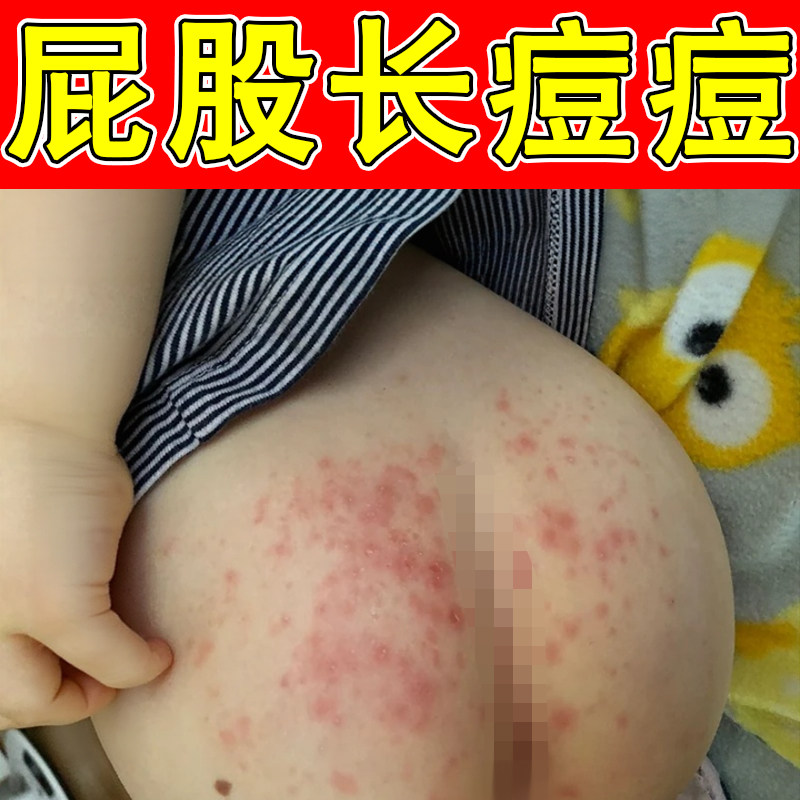 屁股长痘痘久坐闷痘皮肤长小红点屁股痘痘痒起热疙瘩干燥粗糙专用