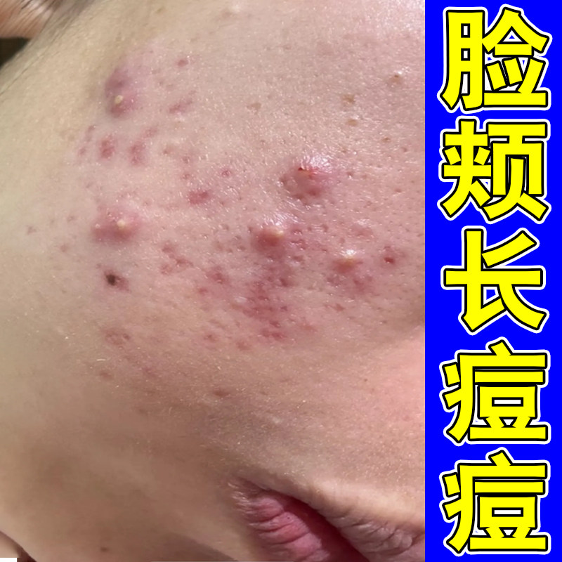 脸颊脸上起红肿疙瘩腮边学生脸上起红疙瘩药额头青春痘外用软膏