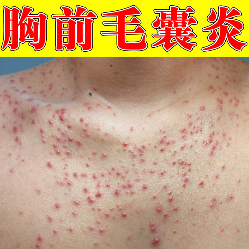 前胸后背长痘痘毛囊炎胸口起红肿脓包痘马拉色菌身上痒起红疙瘩