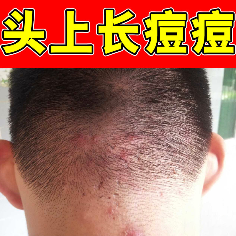 头上长痘痘红肿脓包疙瘩痒专用修复脱皮毛囊痘头油干痒毛囊堵塞痘