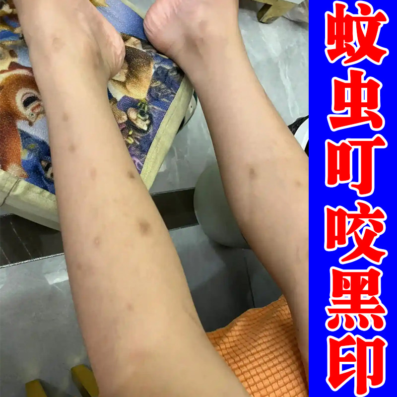 腿上有黑印外用修复蚊虫叮咬祛疤膏疤痕去黑印黑色素沉淀按摩乳膏