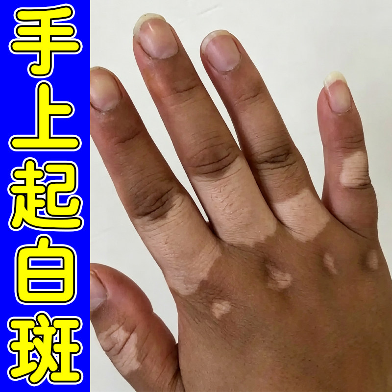 手上起白斑促进黑色素生长外用修复手上长白色斑块汗斑花斑膏