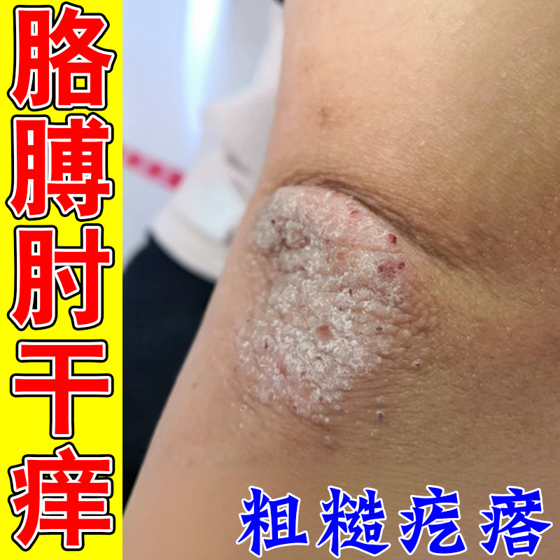 手肘干痒胳膊关节干燥粗糙疙瘩皮肤痒药神经性身上皮肤痒真菌软膏