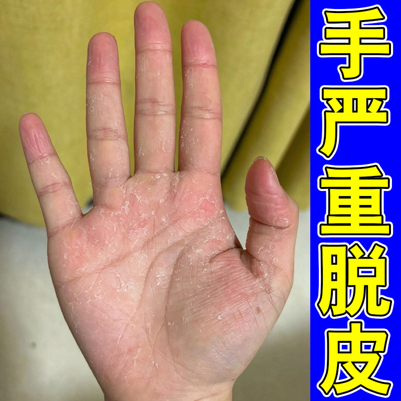 手严重脱皮专用手掌心起皮真菌手蜕皮季节性手指头掉皮干燥粗糙药
