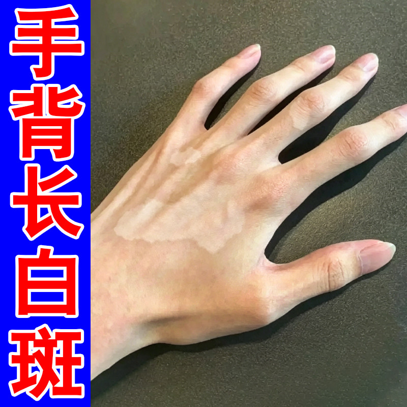 手背长白斑遮盖药外用促进黑色素生长补骨脂酊修复手上白斑膏