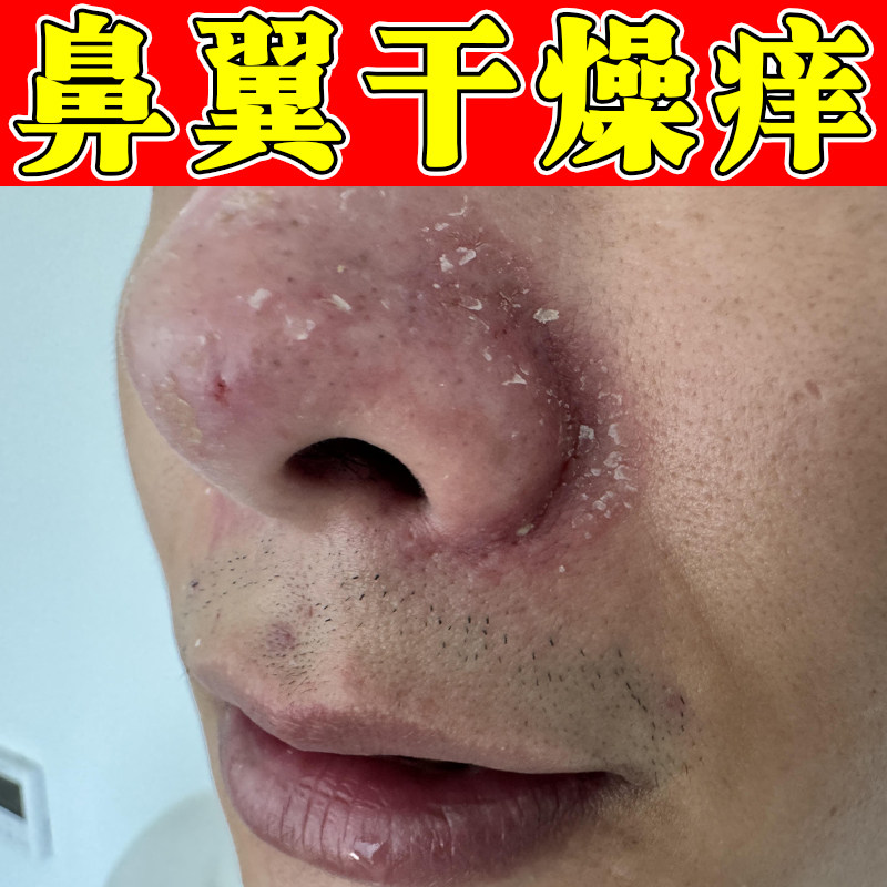 鼻翼两侧泛红修复溢脂性干燥粗糙起皮掉屑痒鼻子发红干痒外用膏