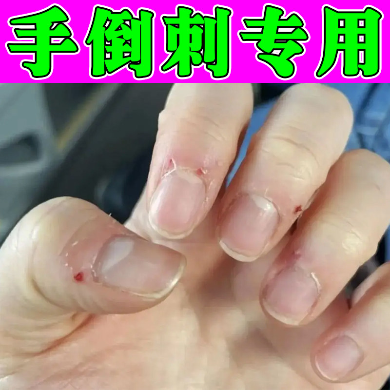 手指倒刺起皮手足裂口膏干裂倒刺起死皮刺痛不敢撕肉甲分离手倒刺