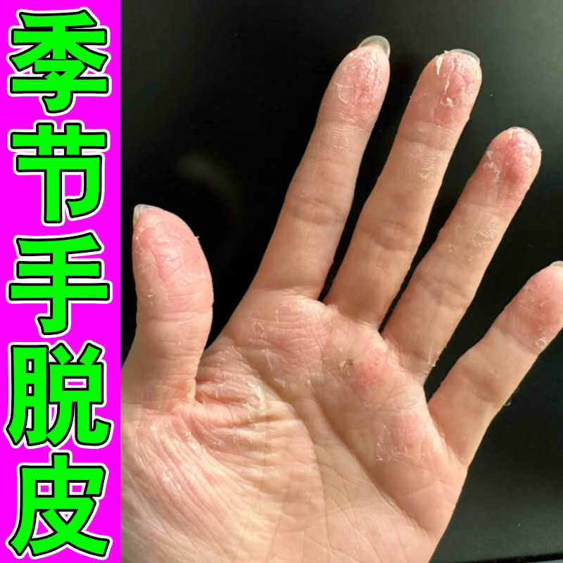 季节性手脱皮干裂真菌专用软膏儿童成人手掌心掉皮干燥粗糙外用药