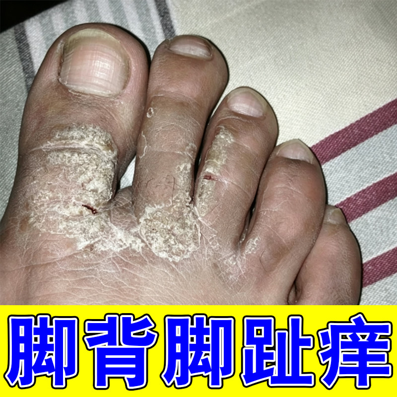 脚背脚趾痒干燥粗糙起皮掉屑脚趾缝痒真菌干痒脚蜕皮脚面脚背痒药