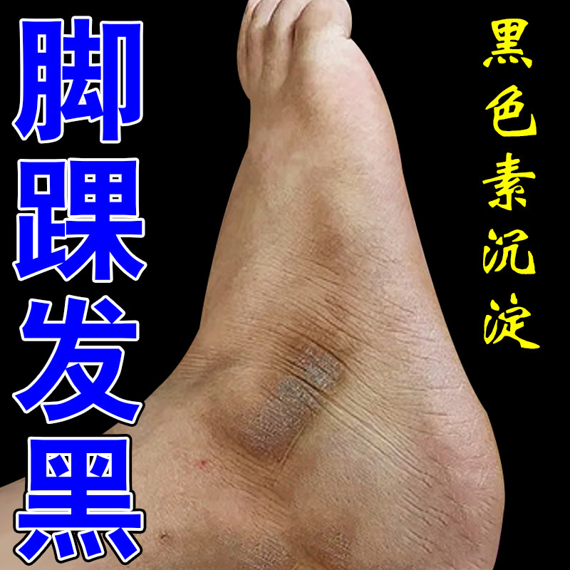 脚踝发黑干燥粗糙脚杆黑色素沉淀脚脖子黑黑的洗不干净