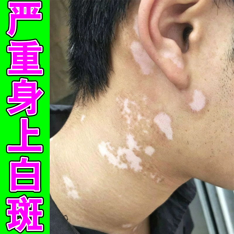 严重身上长白斑修复脖子起白色斑块软膏促进黑色素生长补骨脂酊