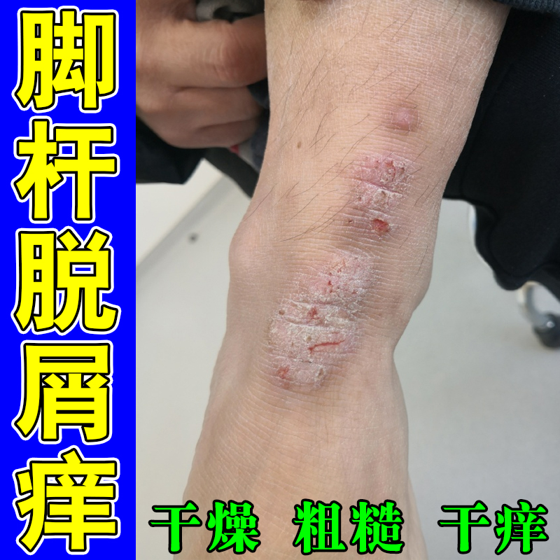 脚杆脱屑痒干燥粗糙干痒脚面脚踝长红斑疙瘩脚背过敏又痒又脱皮膏