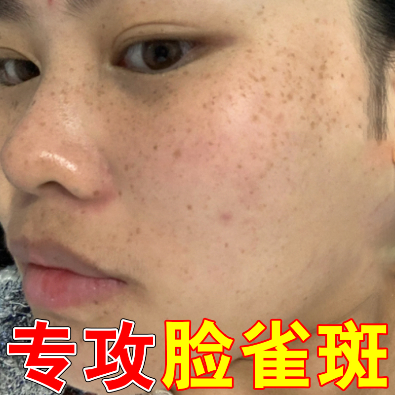 脸颊长色斑黄褐斑老年斑黑色素沉淀斑点脸上长雀斑黑斑满脸斑点膏