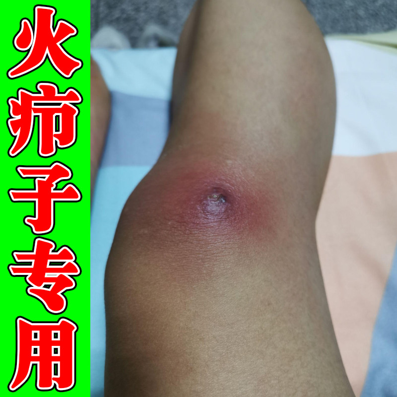 火疖子专用软膏身上红肿疙瘩脓包硬块结节拔毒外用疼痛火疖子的药