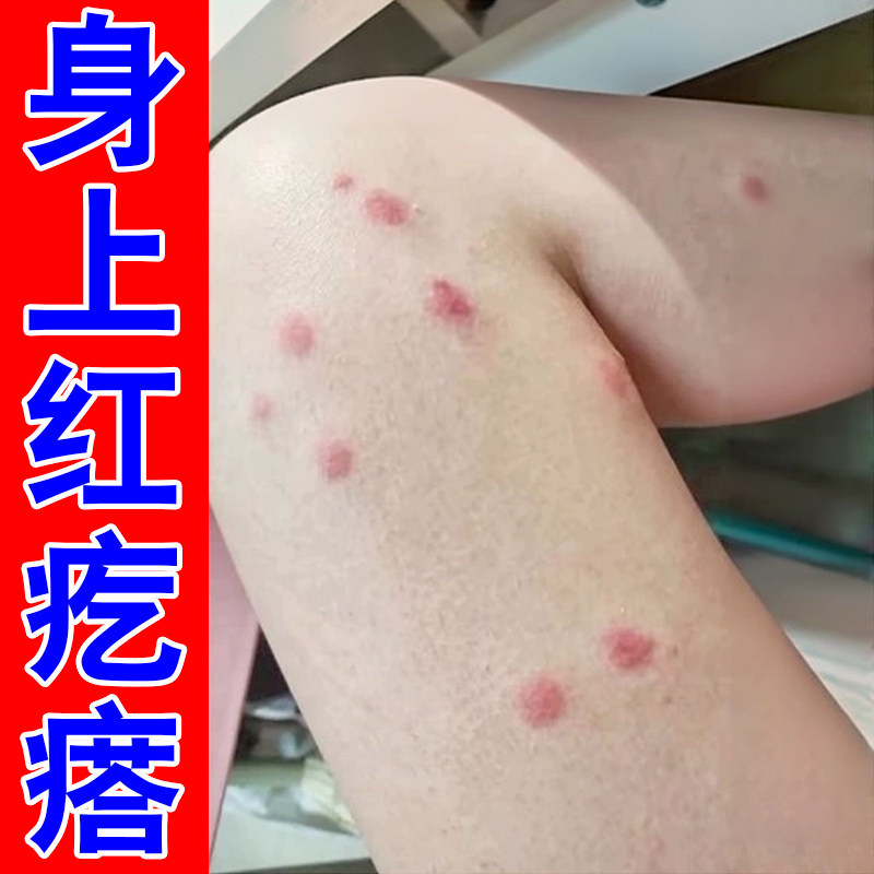 秋冬天冷身上起红疙瘩痒腿部皮肤痒过敏长痘痘小红点外用修复药