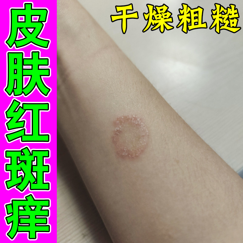 皮肤红斑痒起圆形铜钱疙瘩手臂胳膊过敏干燥粗糙专用皮肤痒软膏药