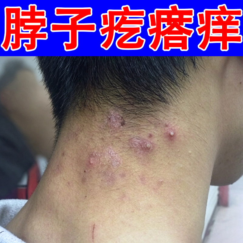 脖子疙瘩痒红斑过敏干痒颈部后面红肿脓包痘干燥粗糙皮肤干痒软膏