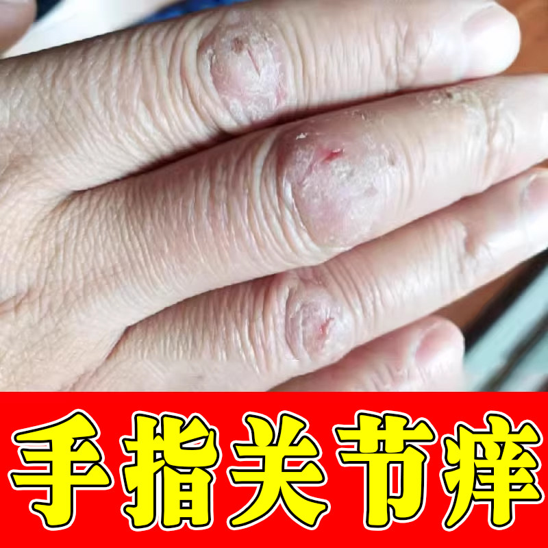 手指关节痒起硬皮疙瘩手干燥粗糙起皮掉屑手指干裂皮肤增厚发痒