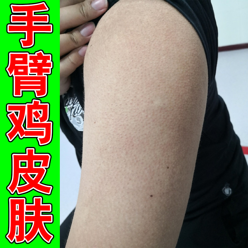 手臂鸡皮肤疙瘩毛周角化症药毛囊堵塞长粗糙颗粒干燥痒外用修复膏