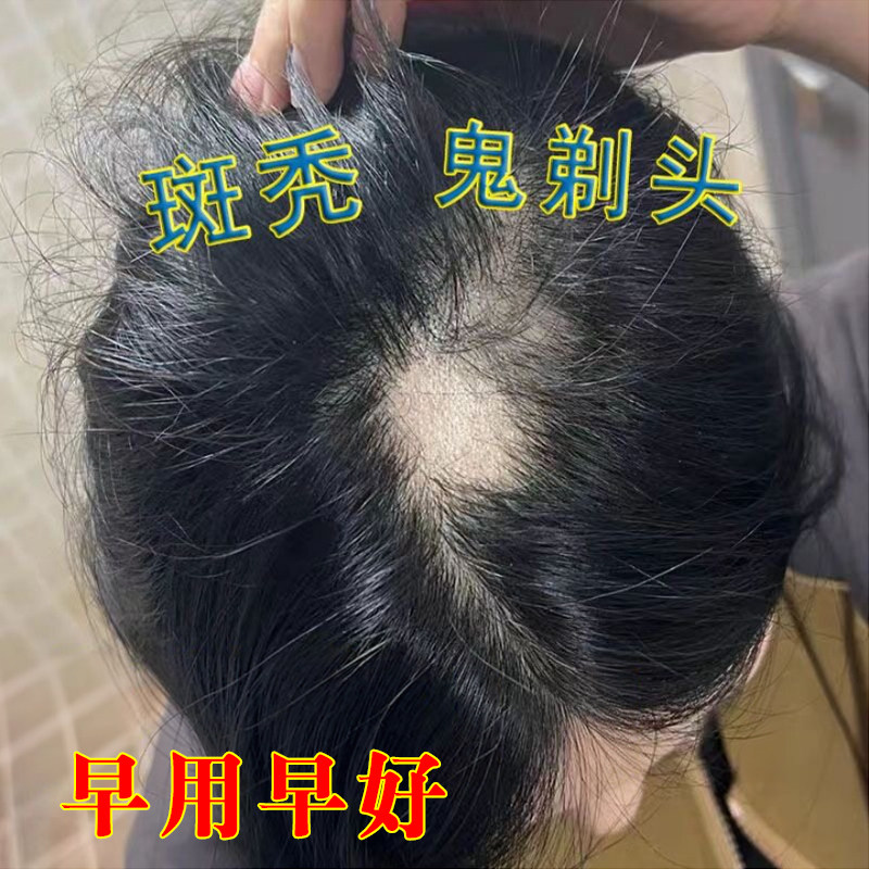 鬼剃头药斑秃液儿童斑秃成块状掉发圆形脱发斑多处缺发头皮秃斑