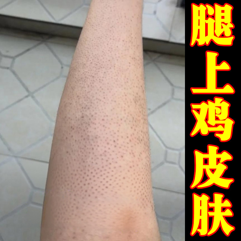 腿上鸡皮疙瘩干燥粗糙毛囊堵塞长小黑点手臂毛周角化症药外用乳膏