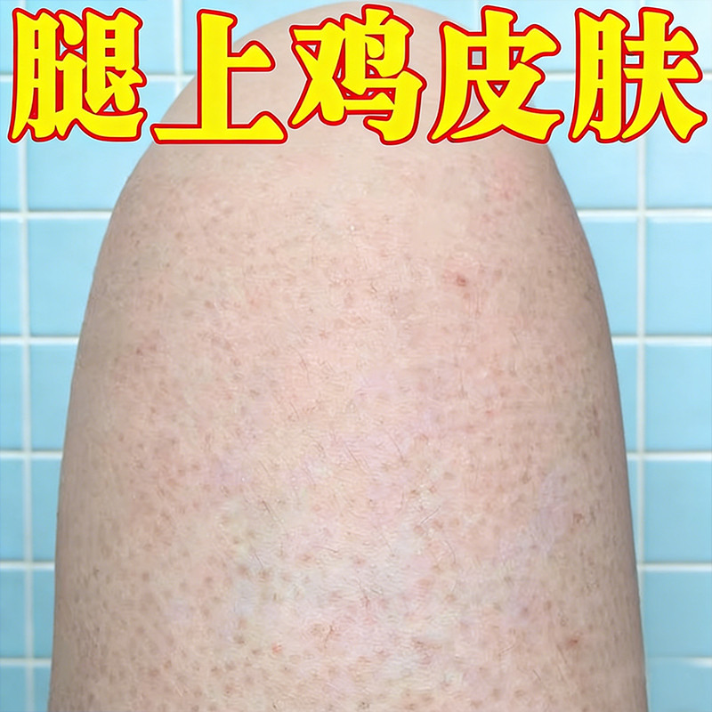 腿上鸡皮疙瘩粗糙颗粒小腿干燥起粗糙小颗粒外用软膏