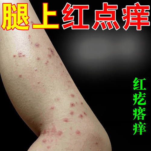 腿上红点痒药皮肤痒长小疙瘩成人儿童宝宝身上痒干燥粗糙专用软膏