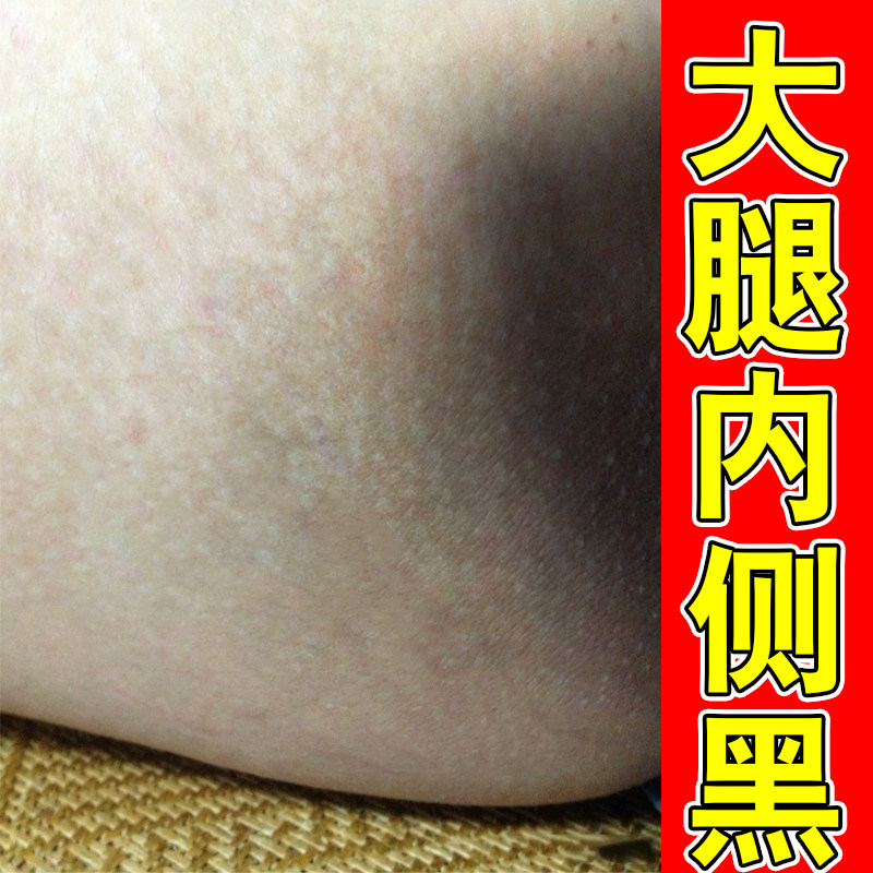 大腿内侧黑黑色素沉淀去药屁股除脖子黑膏坐印臀部发黑私处黑修复