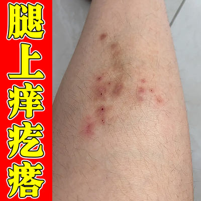 腿痒小腿皮肤痒腿上干燥起皮屑痒身上起红疙瘩小腿痒长小红点软膏