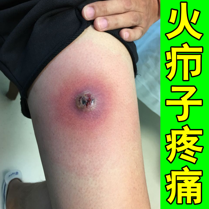 火疖子疼痛红斑发痒出汗刺痛专用修复红肿硬块疙瘩毛囊红痒药软膏