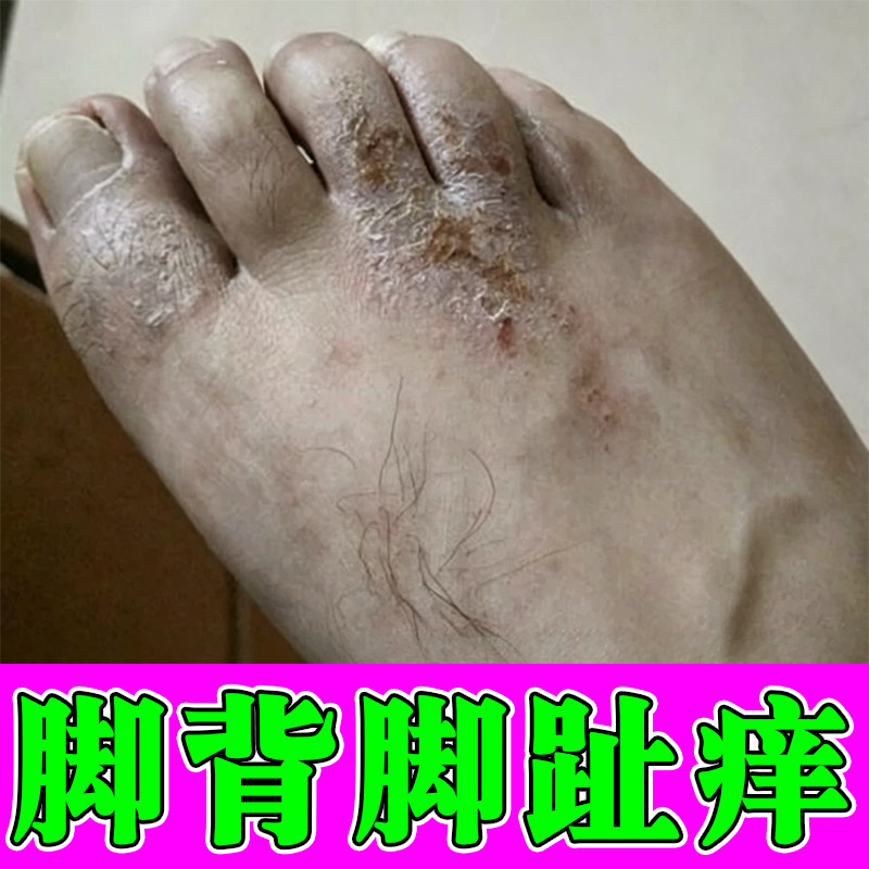 脚背脚趾痒脱屑起皮干燥粗糙真菌脚缝痒脚面红斑起疙瘩干痒外用膏