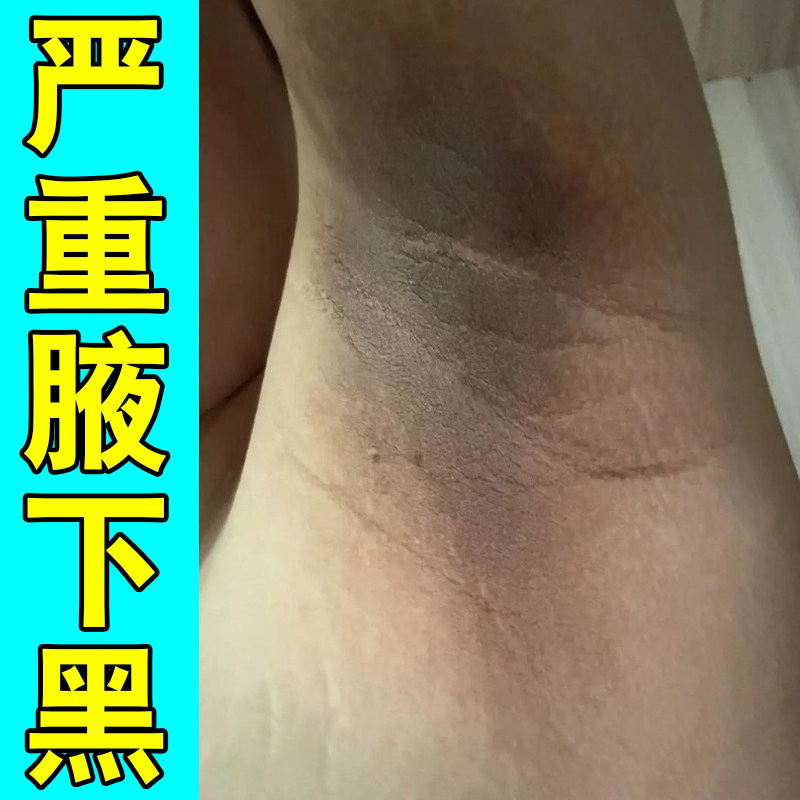 腋下黑皮肤干燥粗糙腋窝摩擦黑色素沉淀脖子黑棘皮外用修复关节黑
