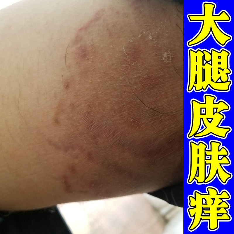 大腿皮肤痒股红斑干燥粗糙色素沉淀真菌大腿内侧痒私处阴囊潮湿
