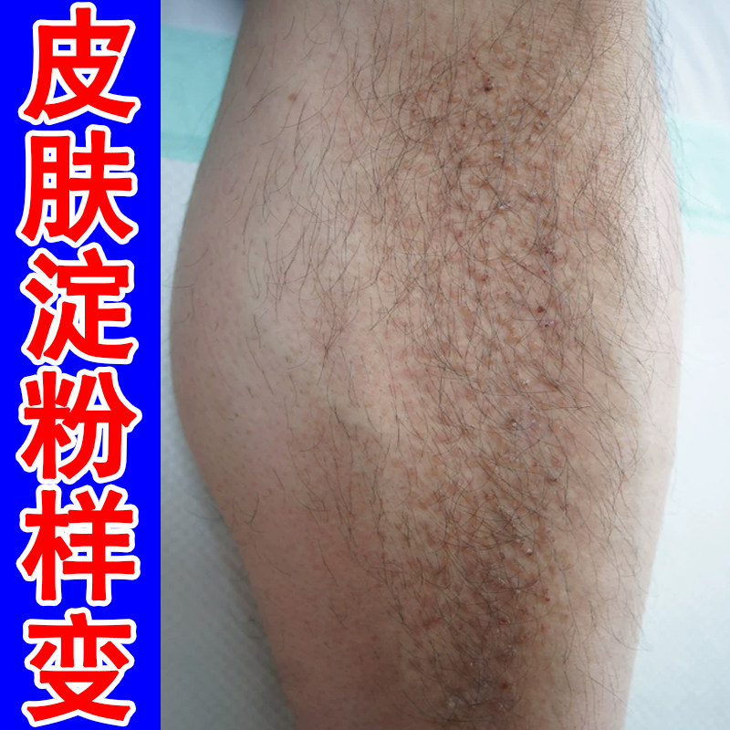 皮肤斑状颗粒粗糙小腿痒长小丘硬疙瘩改善腿部干燥疙瘩痒外用乳膏