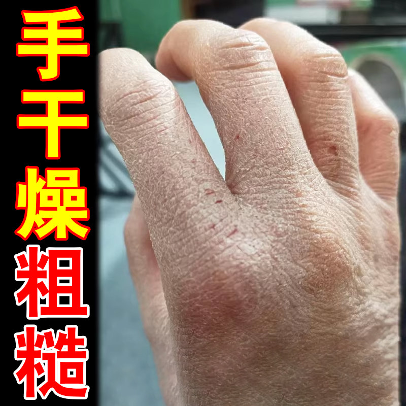 手粗糙蜕皮专用真菌掉皮干燥起皮去手背干裂口子疼痛手指关节粗糙